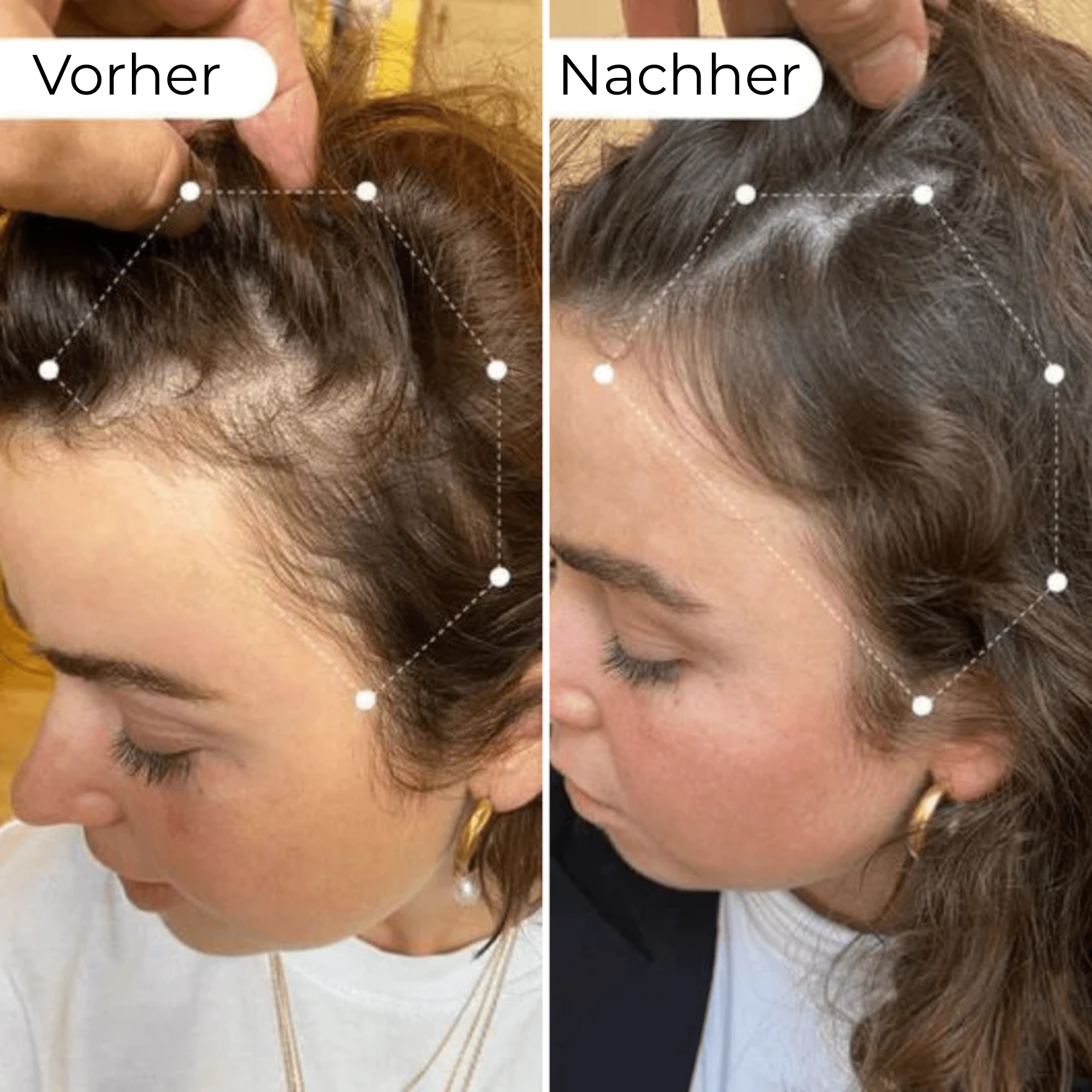 8-wöchige Haarausfall-Reduktionskur